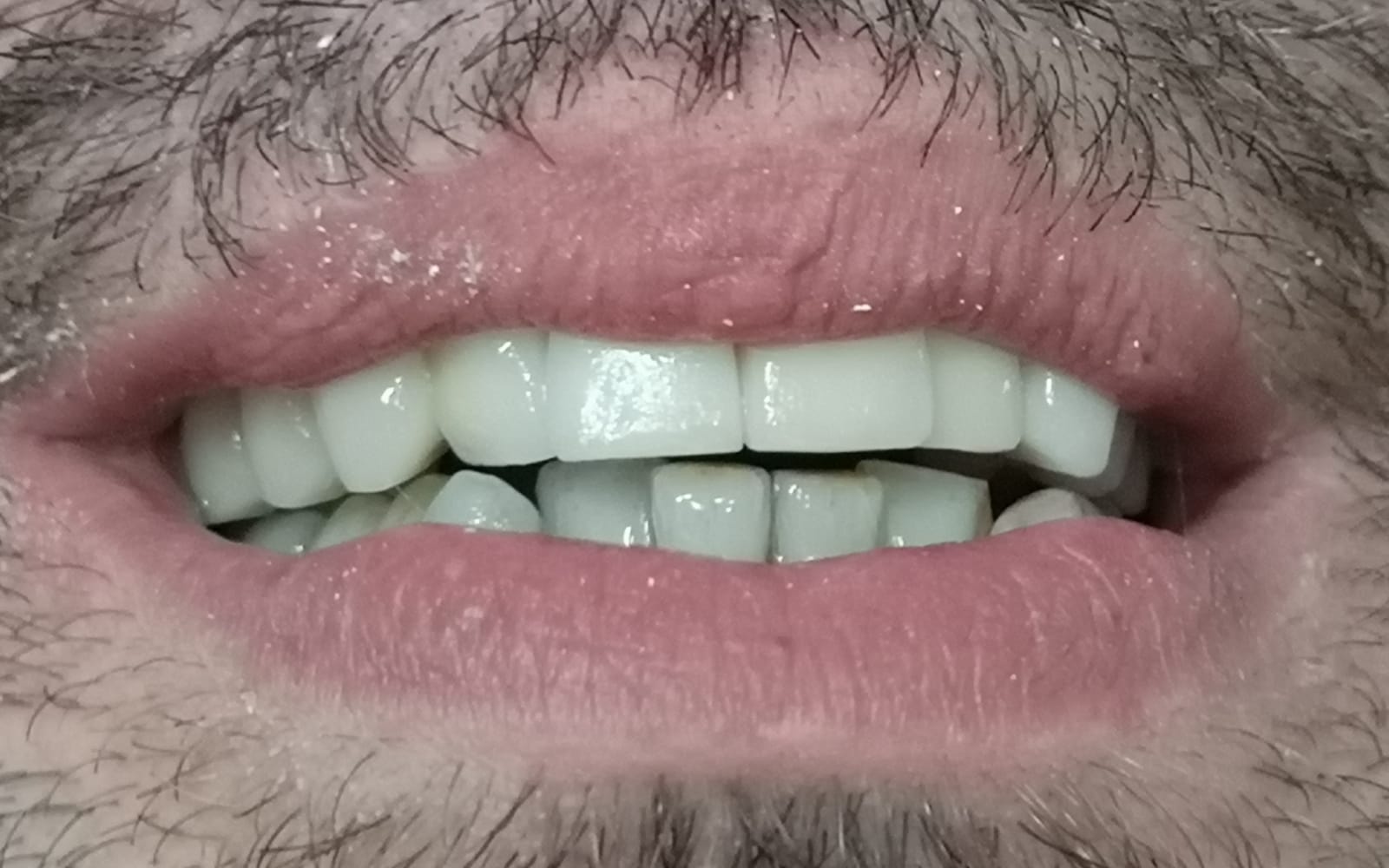 Foto dopo l'applicazione di una protesi fissa