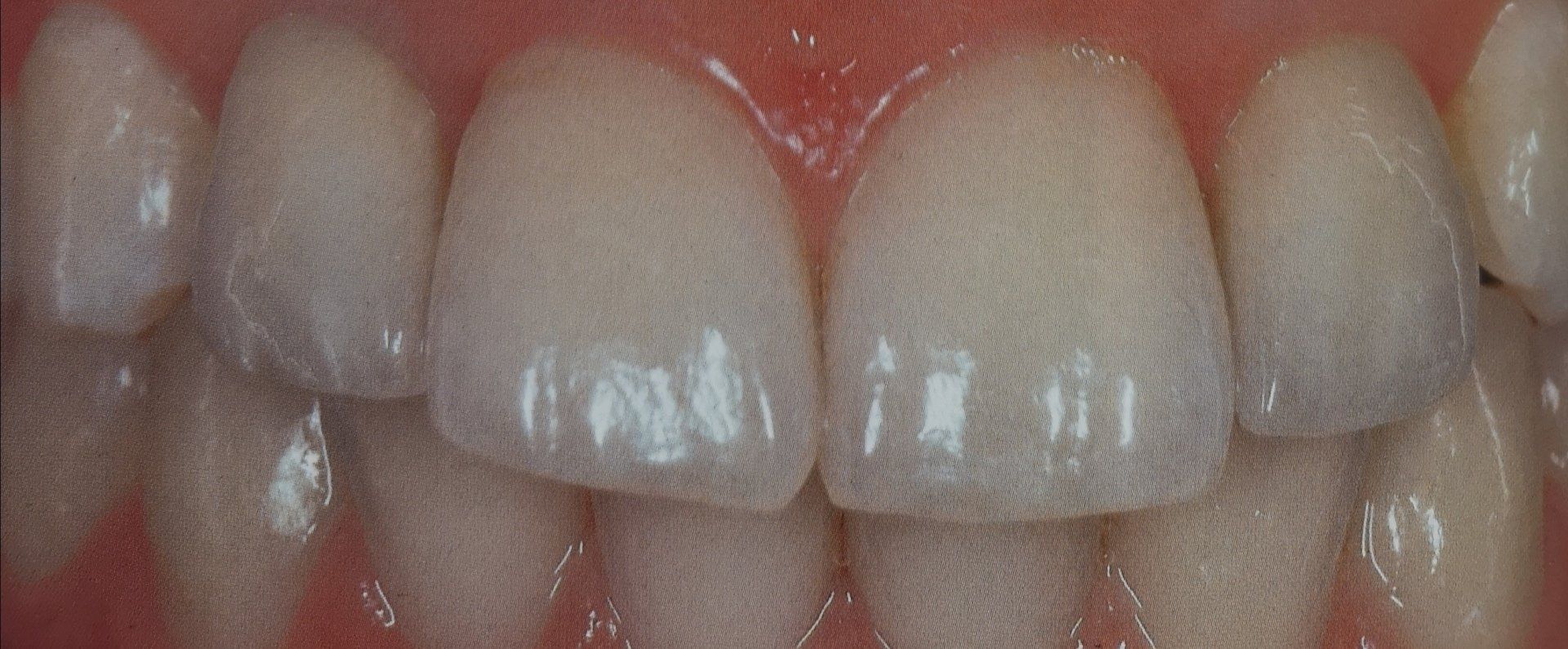 Primo piano di denti sani e bianchi. Sono visibili le gengive rosa.