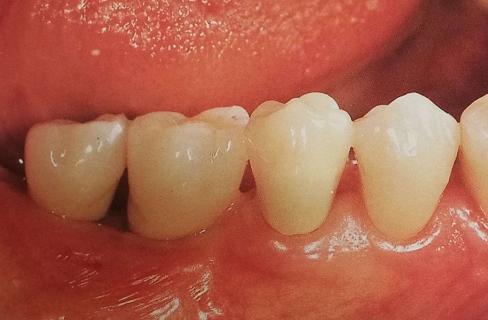 Primo piano di denti e gengive sani in bocca.
