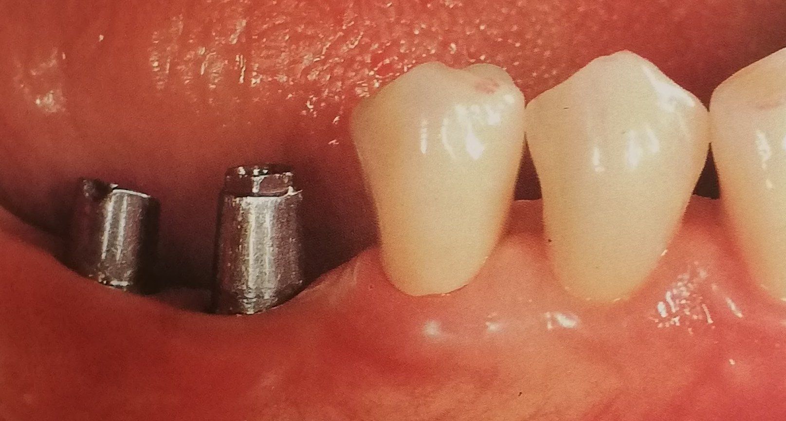 Primo piano della bocca che mostra due impianti dentali metallici accanto a due denti naturali con gengive rosa.