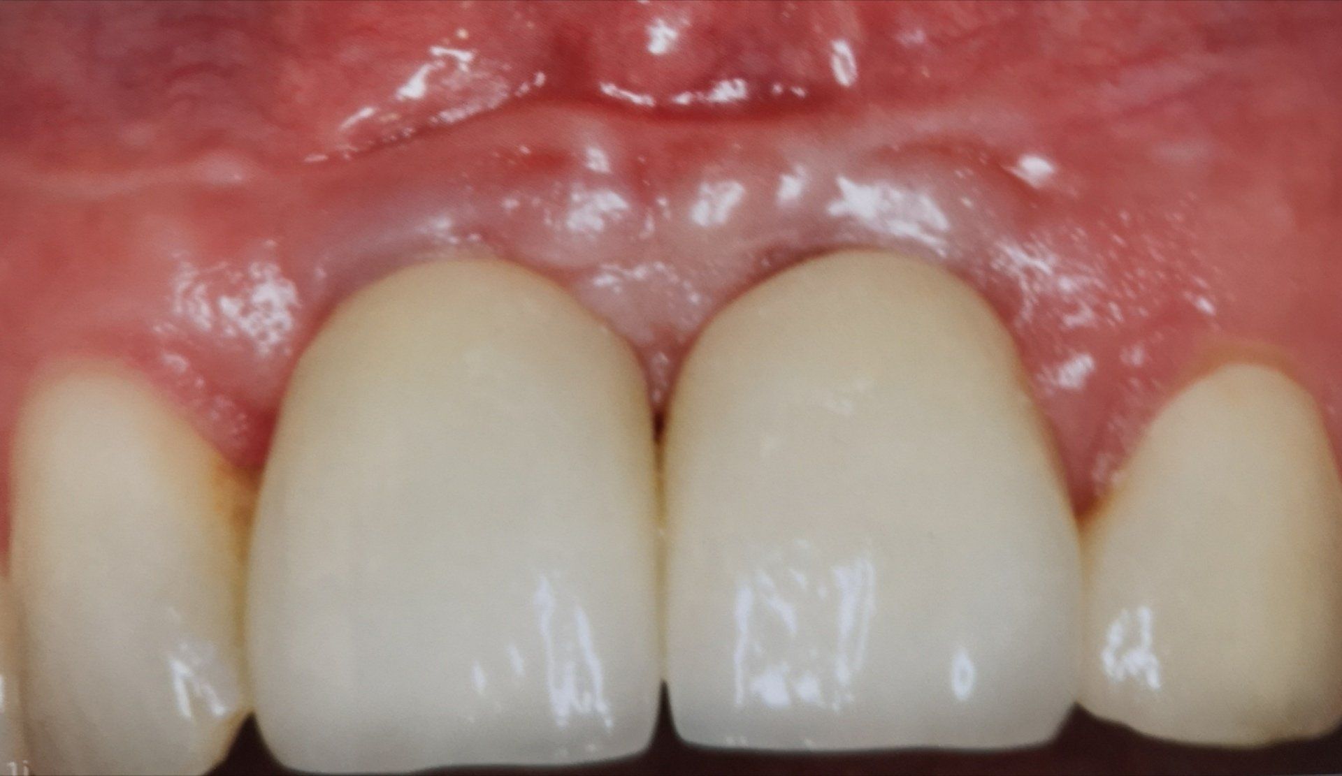 Primo piano della bocca di una persona che mostra due denti centrali con corone bianche e gengive rosa sane.