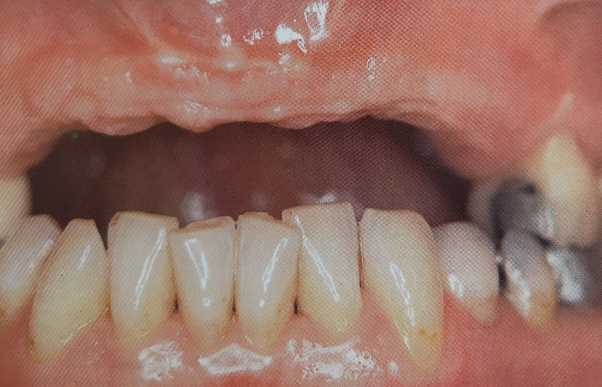 Primo piano di una bocca aperta. I denti visibili sono giallastri e presentano alcune otturazioni; mancano i denti superiori e le gengive.