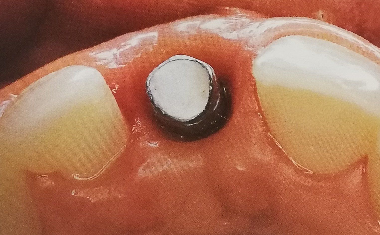 Un impianto dentale con la parte superiore bianca e la base scura, circondato da tessuto gengivale e denti.