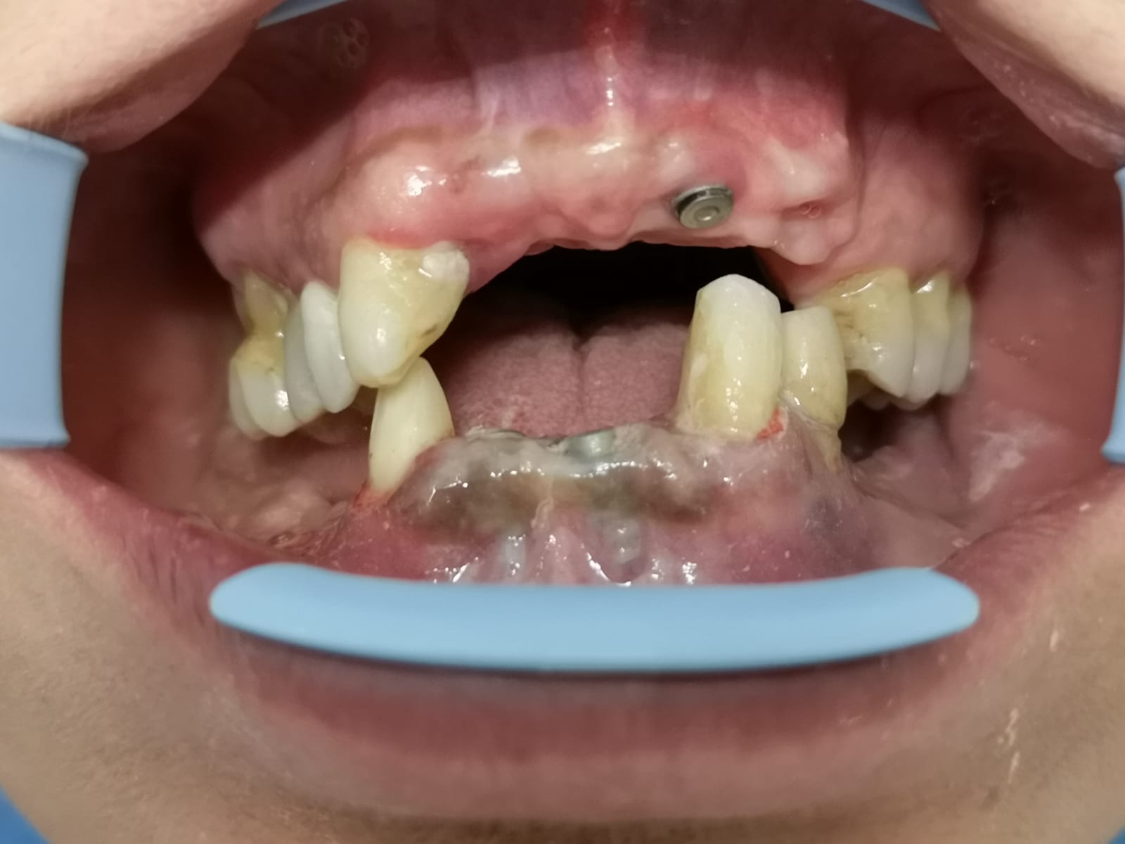 Arcata dentale prima dell'applicazione dell'impianto dentale