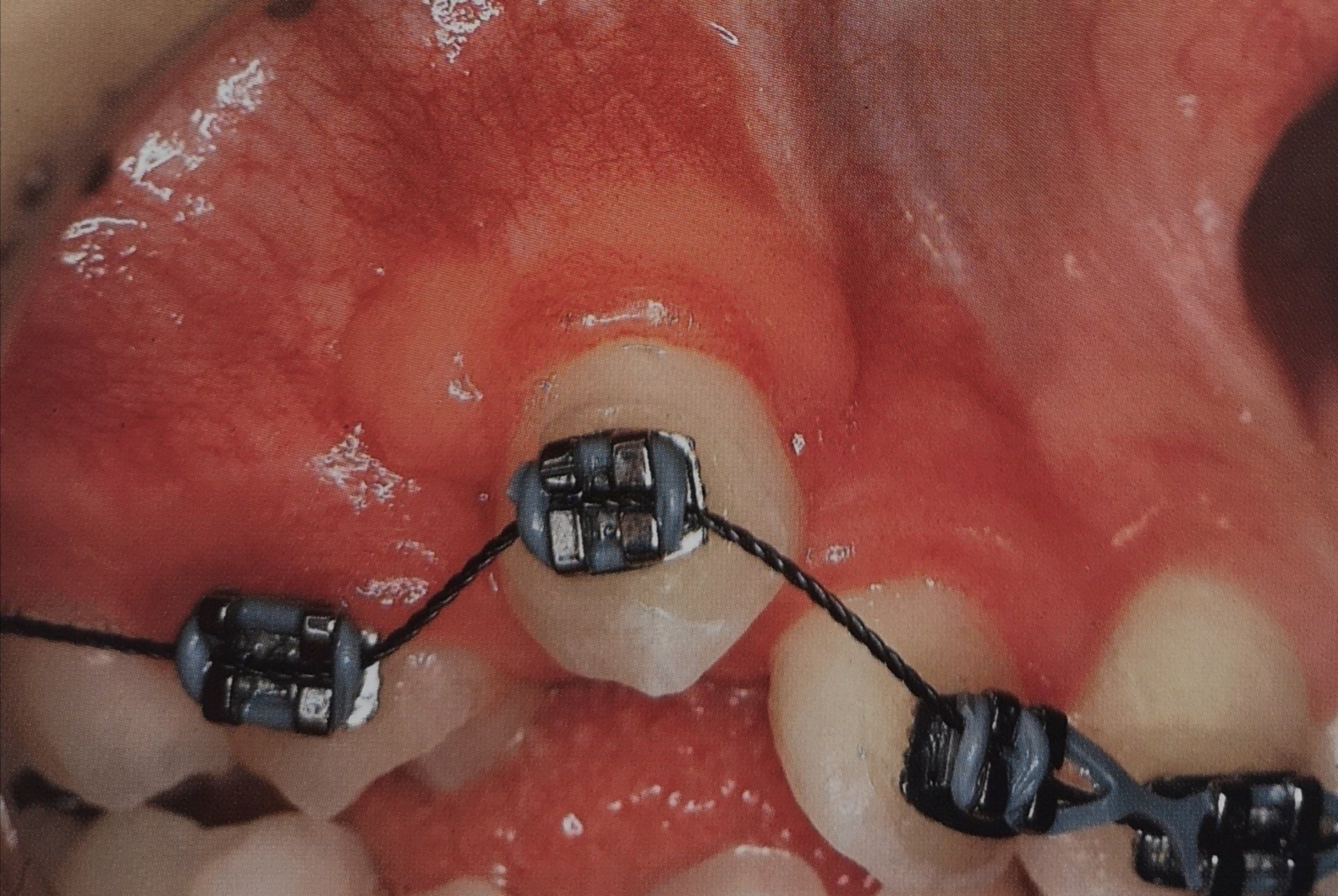 Primo piano di una bocca con apparecchio ortodontico sui denti superiori, che mostra un dente con bracket parzialmente erotto.