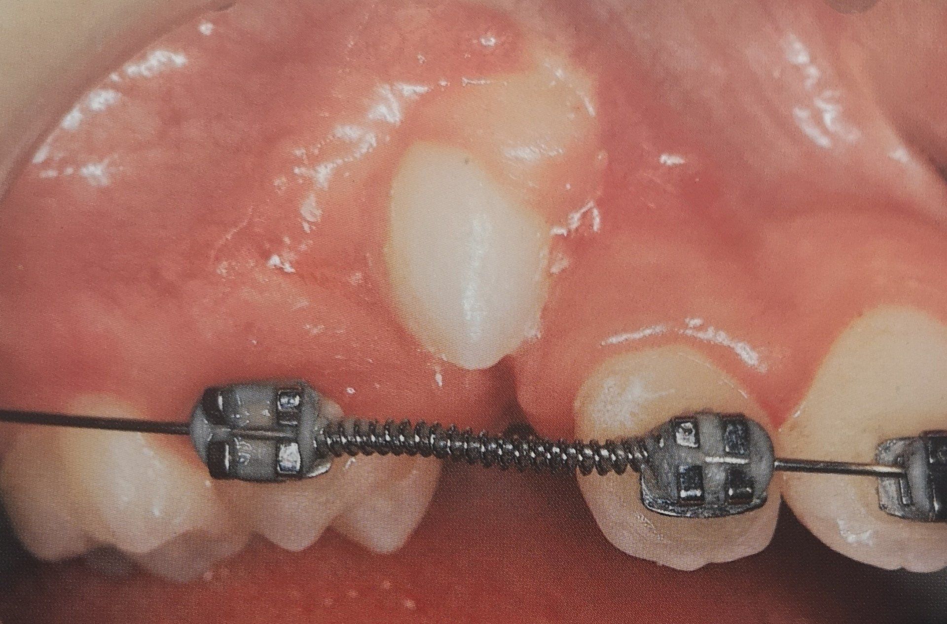 Primo piano della bocca con l'apparecchio ortodontico, la molla spinge in avanti il dente, dente parzialmente erotto visibile.