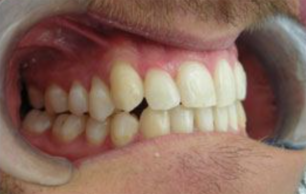 Primo piano dei denti di una persona con un retrattore dentale in posizione, che rivela denti dritti e bianchi.