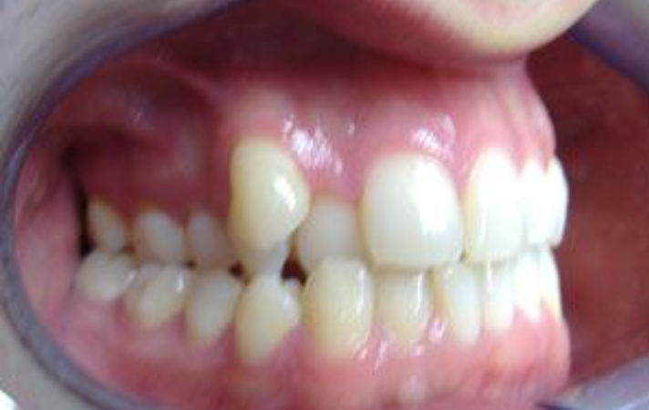 Bocca con denti disallineati, un dente sporgente.