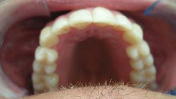 Interno della bocca con i denti superiori in evidenza. I denti sono bianchi e leggermente gialli. Le gengive sono rosa.