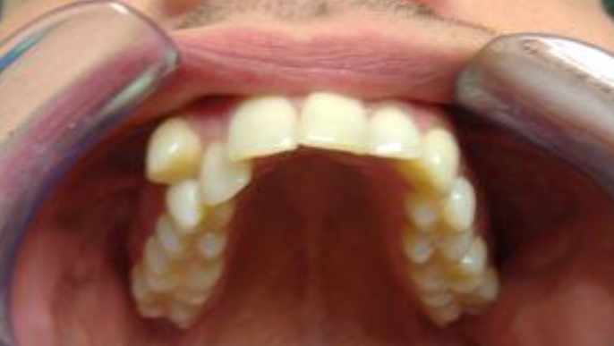Primo piano della bocca aperta di una persona, che mostra i denti superiori e inferiori con un retrattore dentale in posizione.