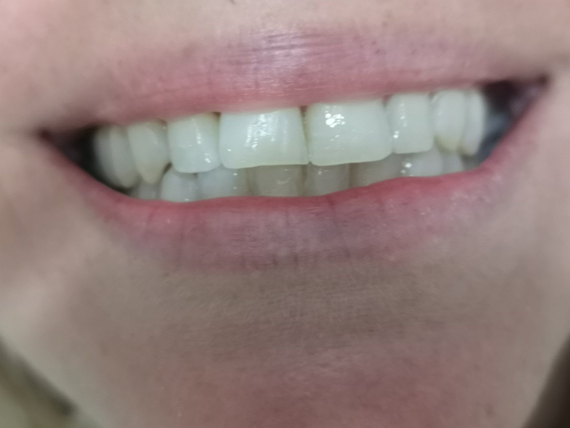 Primo piano della bocca sorridente di una persona che mostra denti bianchi e sani e gengive rosa.