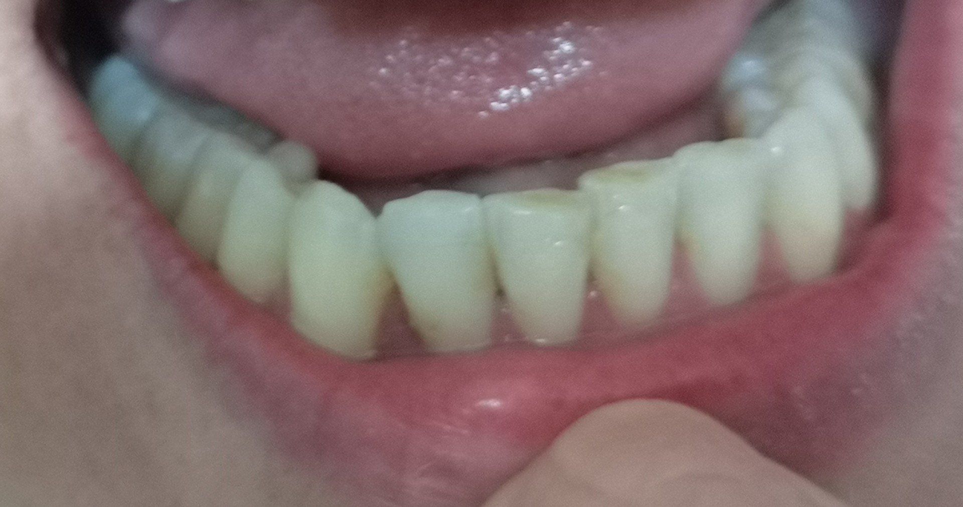 Primo piano dei denti umani in bocca; i denti sono ingialliti.