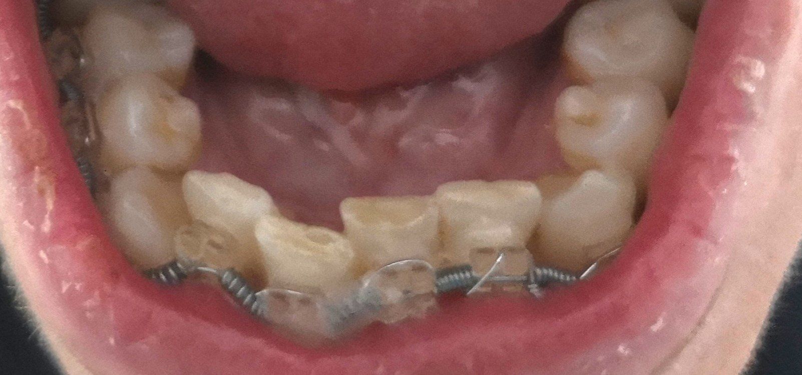 Primo piano dei denti con apparecchio metallico, nella parte inferiore. Bocca aperta che mostra denti, gengive e lingua.