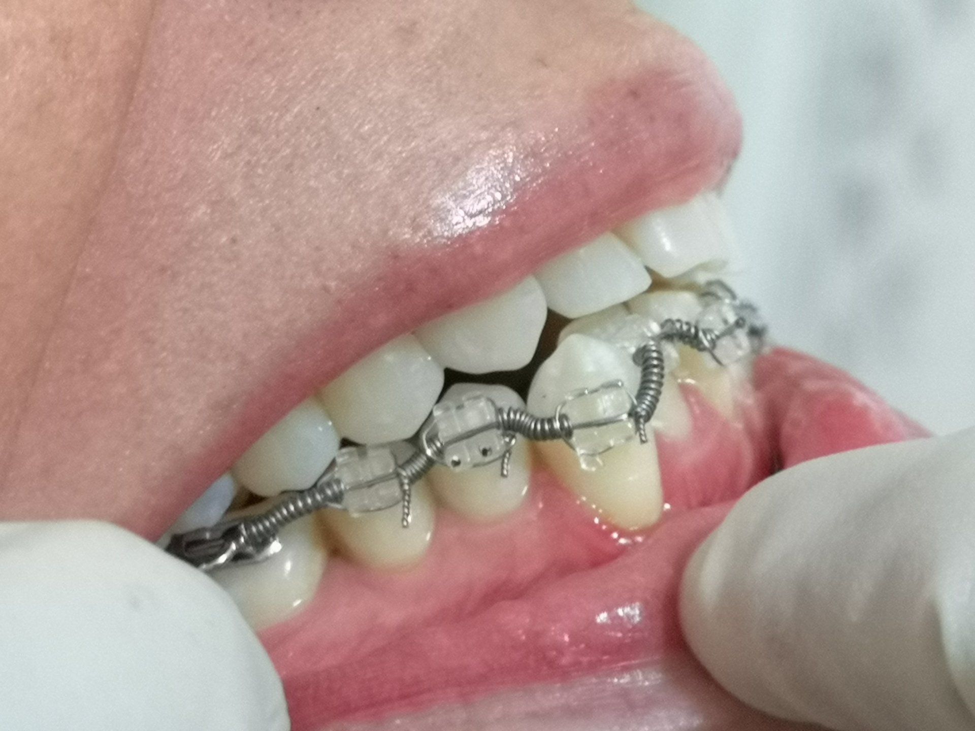 Primo piano della bocca di una persona con un apparecchio ortodontico trasparente; una mano guantata tiene la guancia della persona.