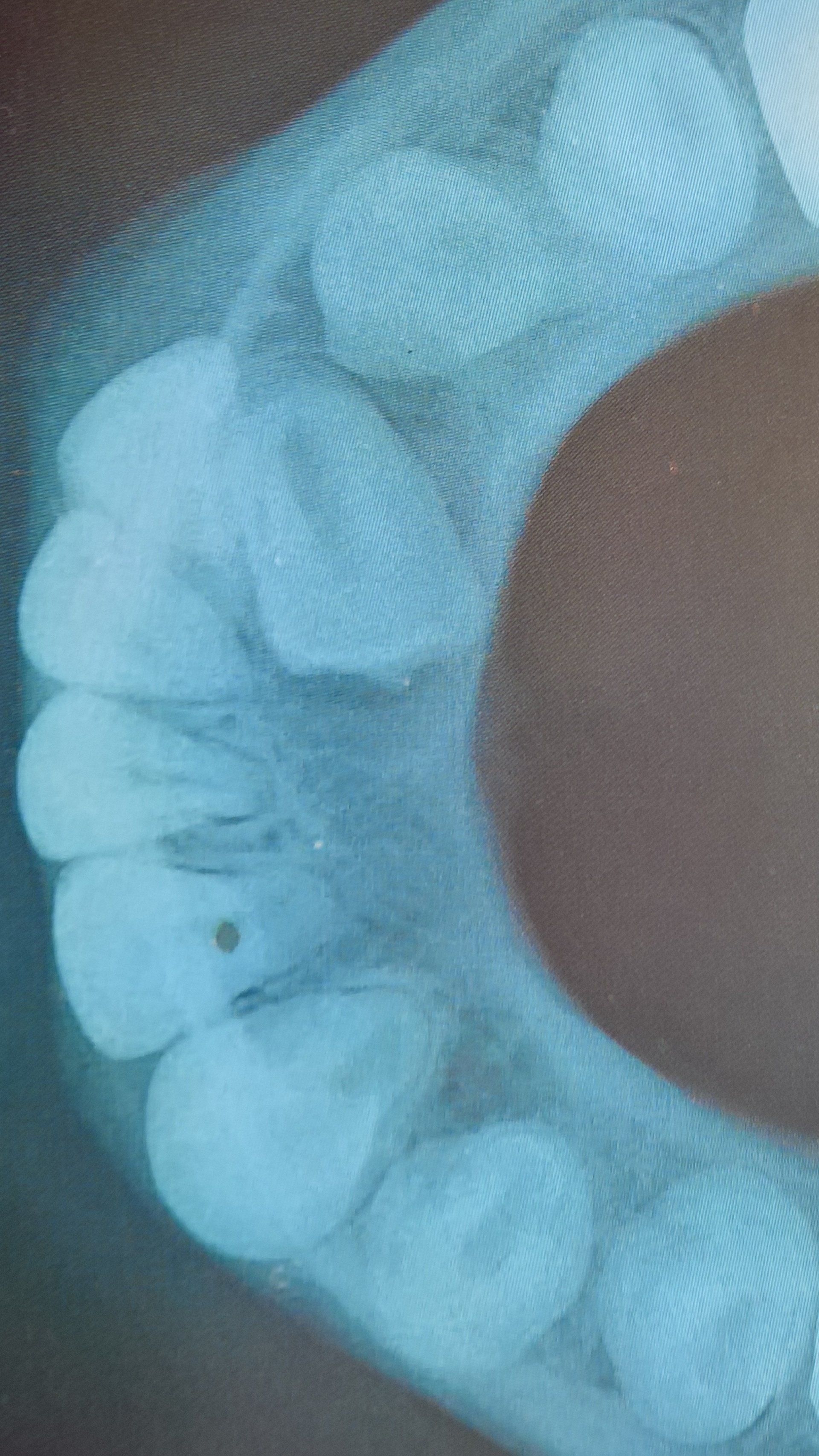 Radiografia dentale che mostra i denti superiori e la struttura ossea circostante. È visibile una macchia scura su un molare.