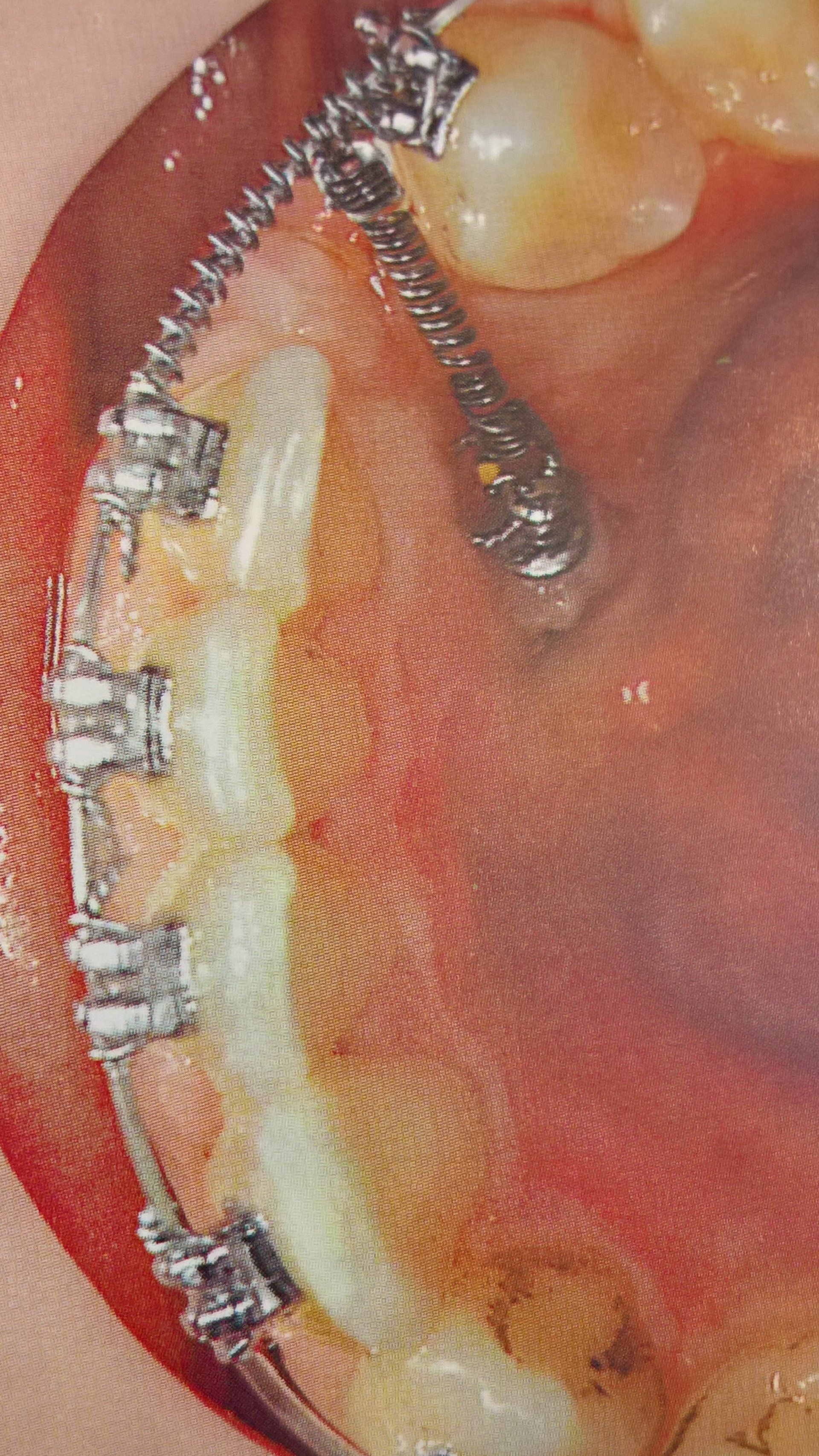 Bocca con apparecchio ortodontico, dotato di meccanismo a molla per spostare i denti.