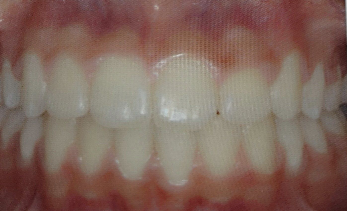 Primo piano dei denti superiori e inferiori, che mostrano l'allineamento e una piccola macchia scura su un dente.