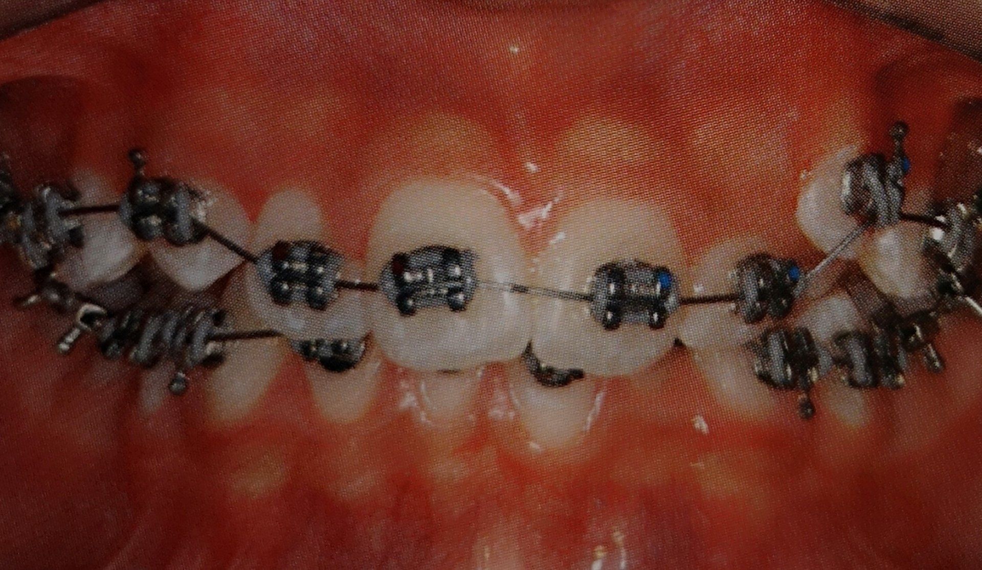 Primo piano dei denti con apparecchi metallici.