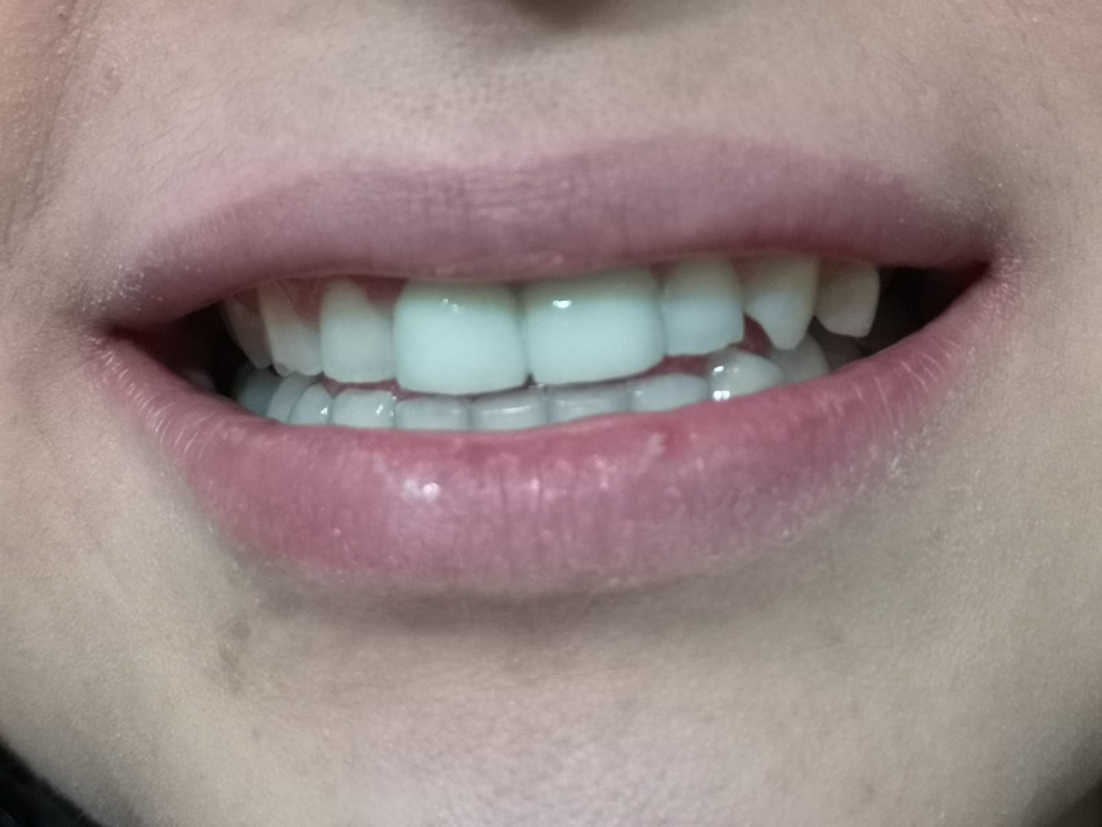 Primo piano di una persona sorridente, che mostra denti bianchi e uniformi e labbra rosa, carnose e lucide.