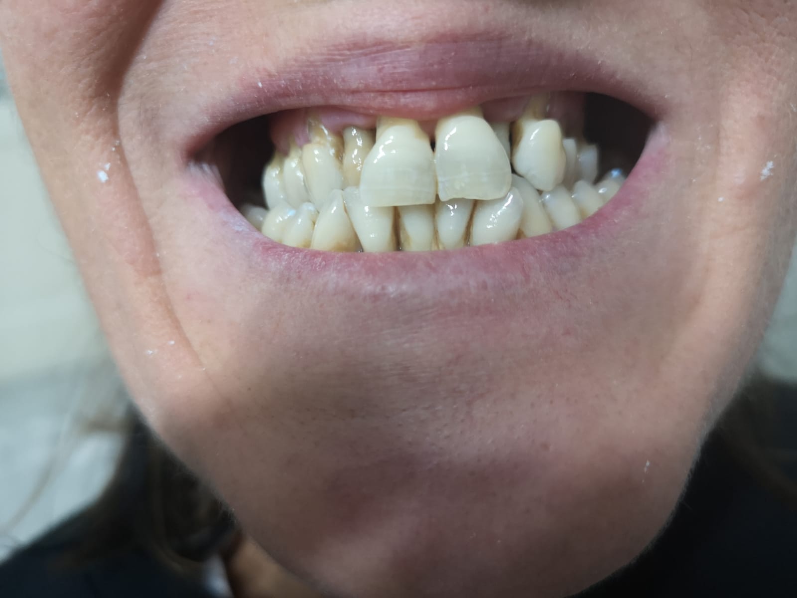 Paziente che necessita di trattamento ortodonico