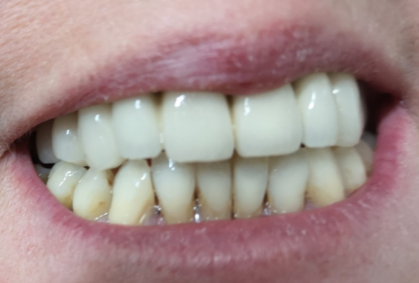 Paziente dopo trattamento ortodonico per riallineamento denti