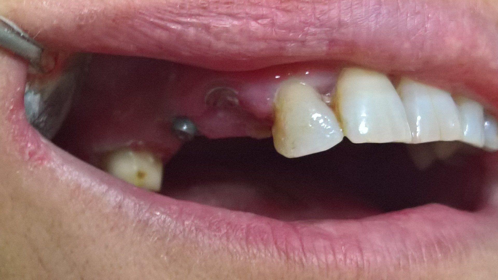 Protesi fissa, prima