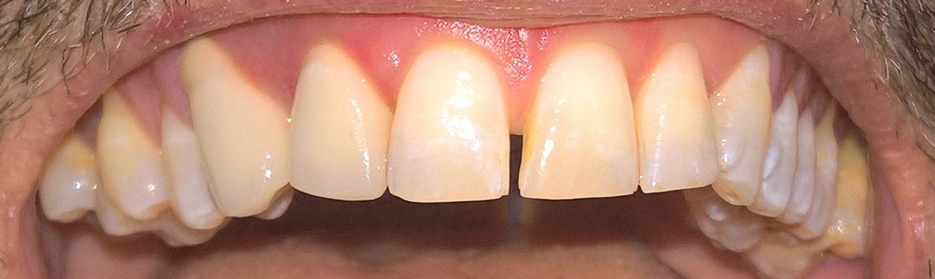 Studio dentistico Lombardi, esempio di protesi fissa, dopo