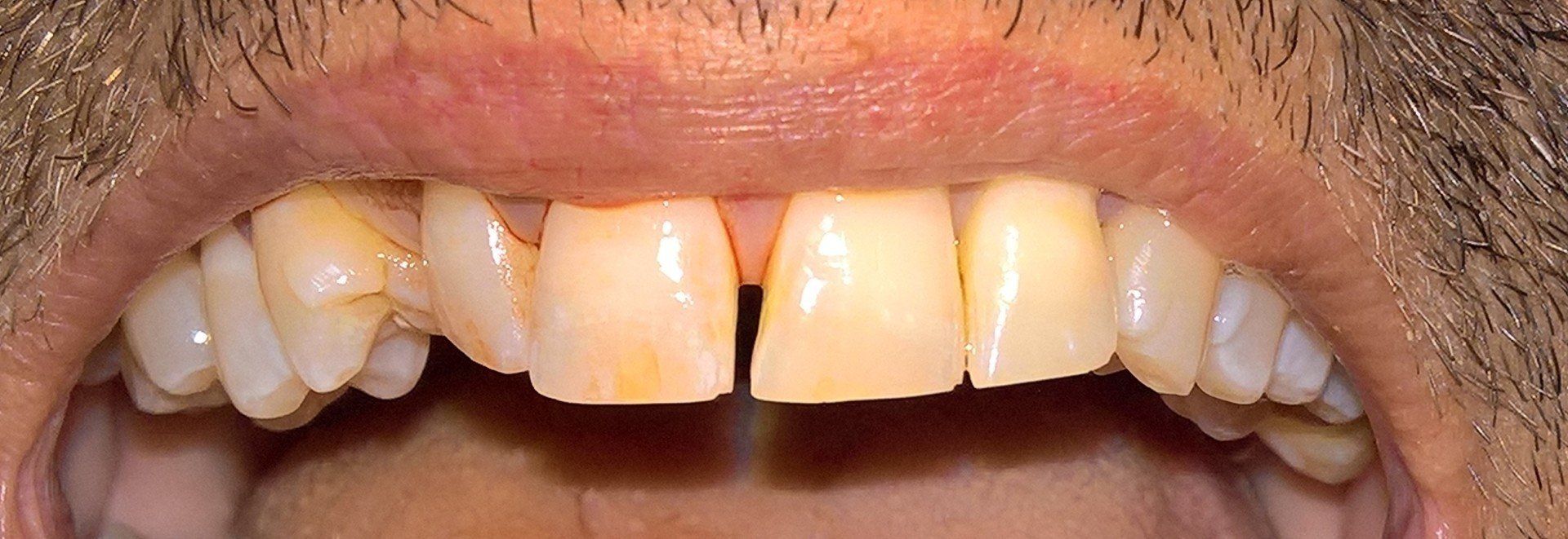 Studio dentistico Lombardi, esempio di protesi fissa, prima