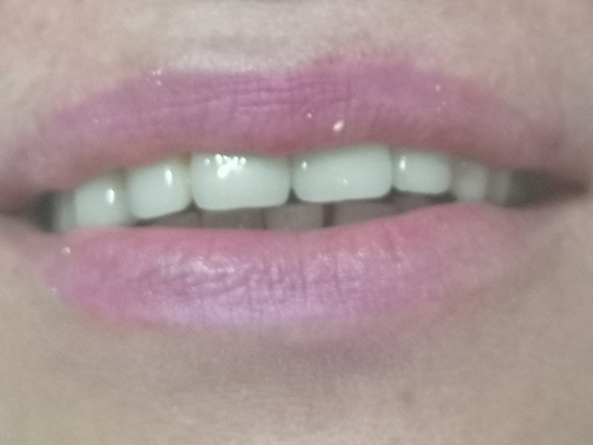 Studio dentistico Lombardi, esempio di arcata dopo intervento diprotesi fissa