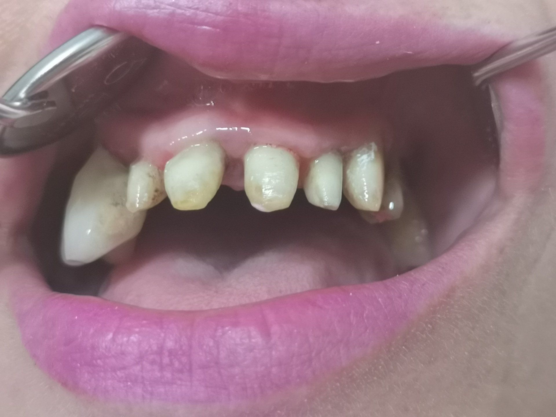 Studio dentistico Lombardi, esempio di arcata prima di intervento diprotesi fissa