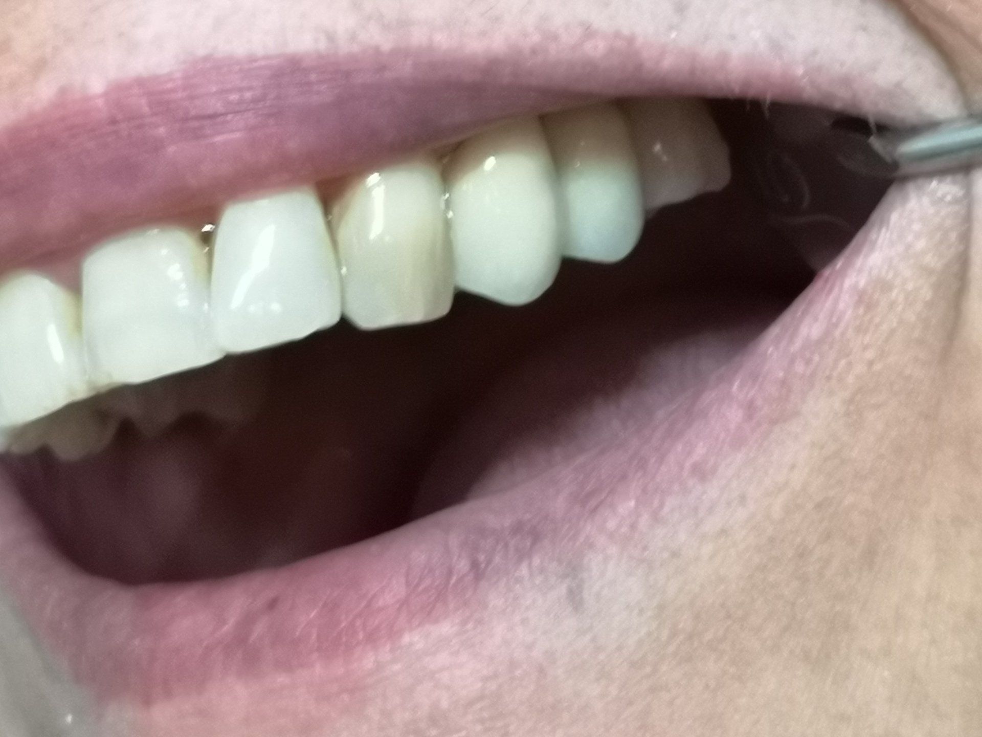 protesi dentaria fissa