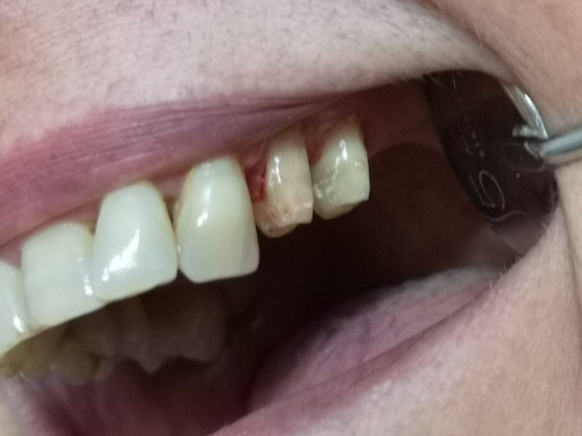 Un primo piano della bocca di una persona a cui manca un dente.