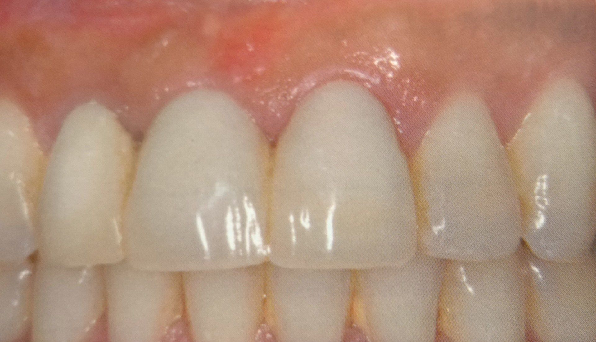 Vista ravvicinata dei denti umani: gli incisivi centrali sono ricoperti e circondati dalle gengive e dai denti adiacenti.