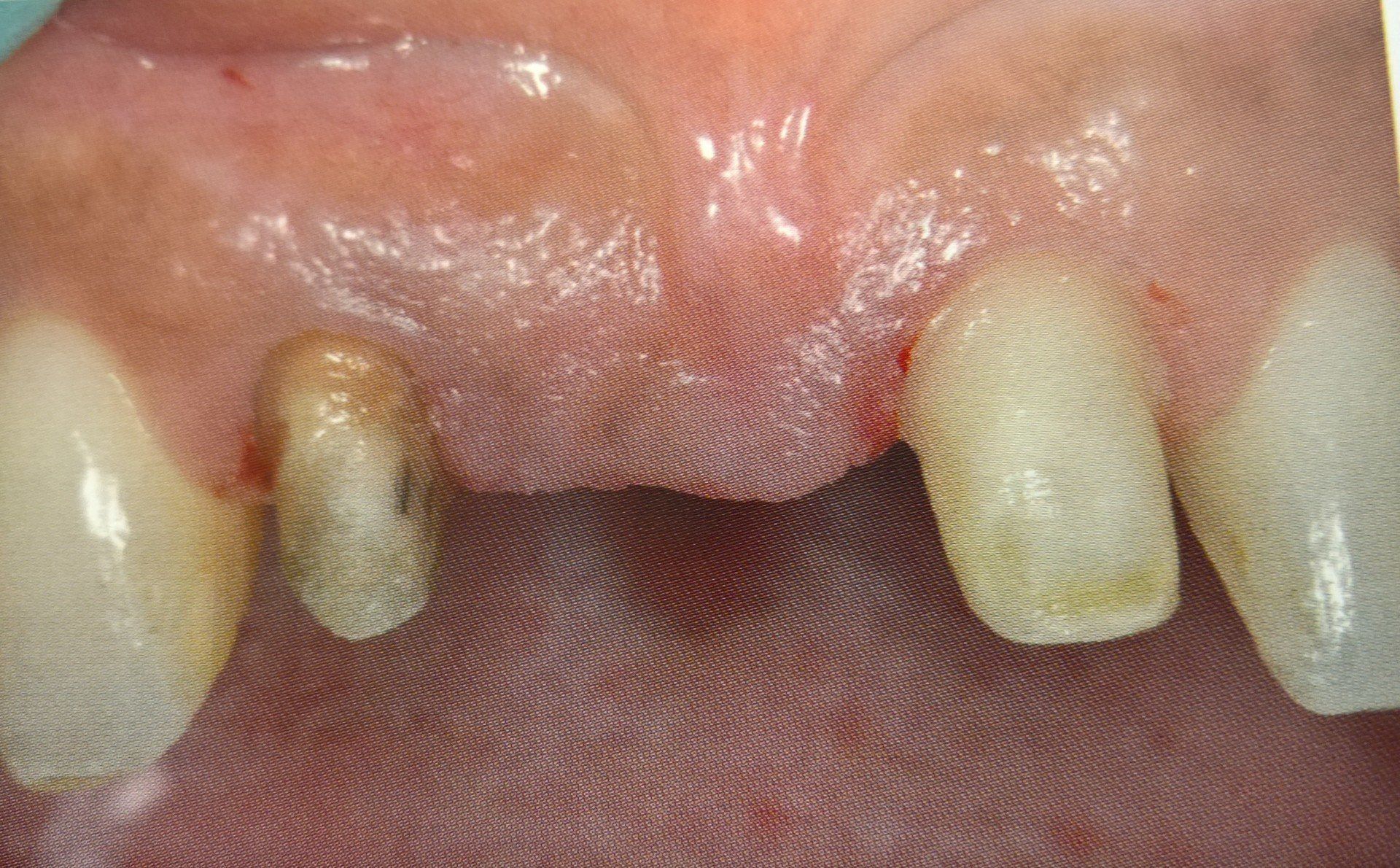 Primo piano dei denti; dente mancante visibile con radice cariata e gengive infiammate.