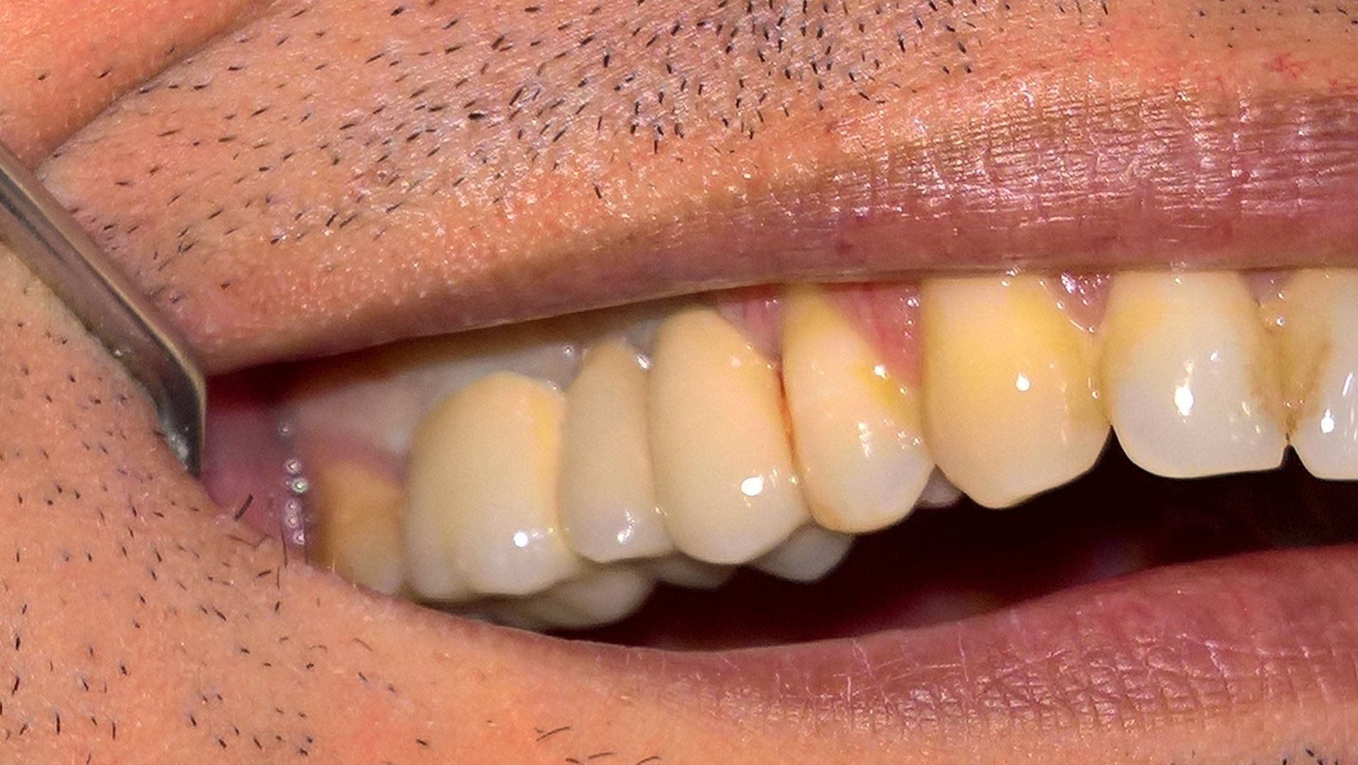 Primo piano della bocca di una persona con denti ingialliti.