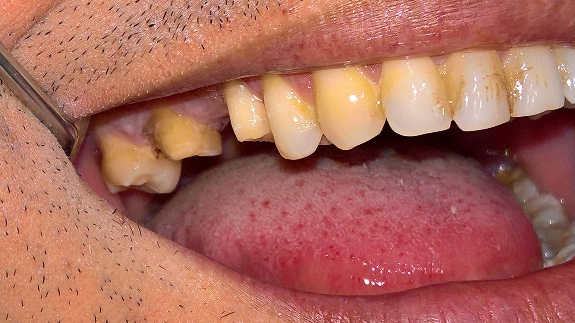 Bocca con denti visibilmente ingialliti e danneggiati, che mostrano segni di usura e possibile carie.