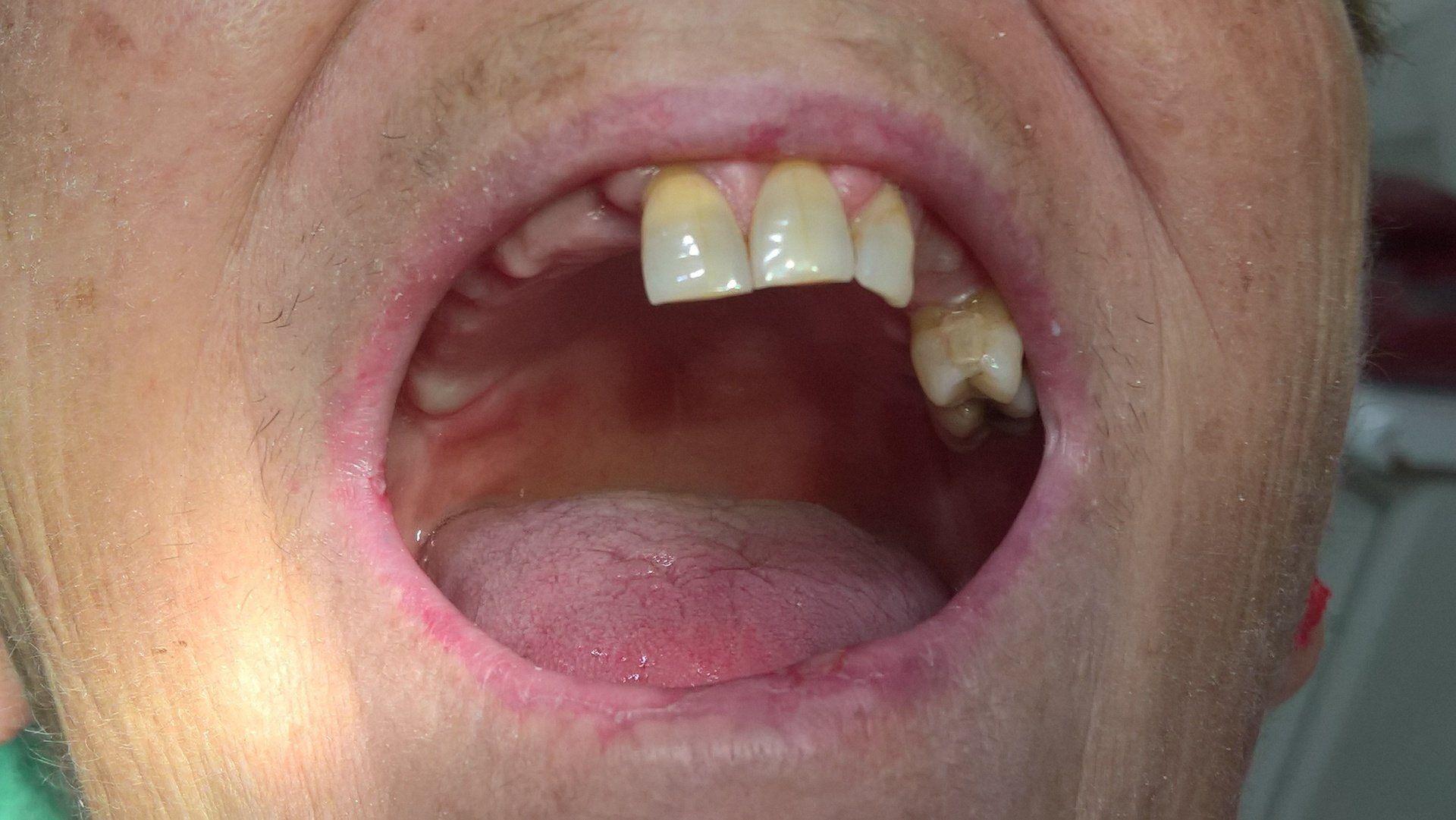 Arcata dentale con denti mancanti