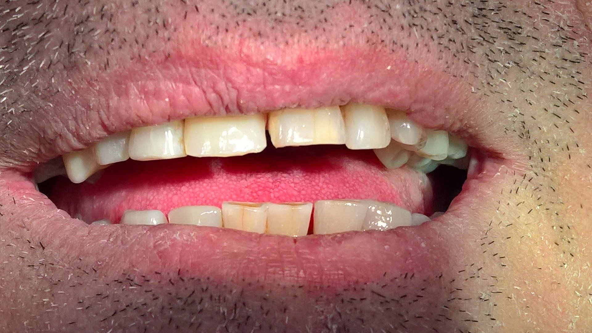 Paziente con protesi mobile applicata dal dentista Paola Daniele Lombardi