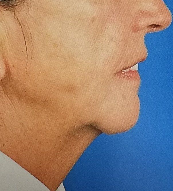 Profilo di paziente con dentiera