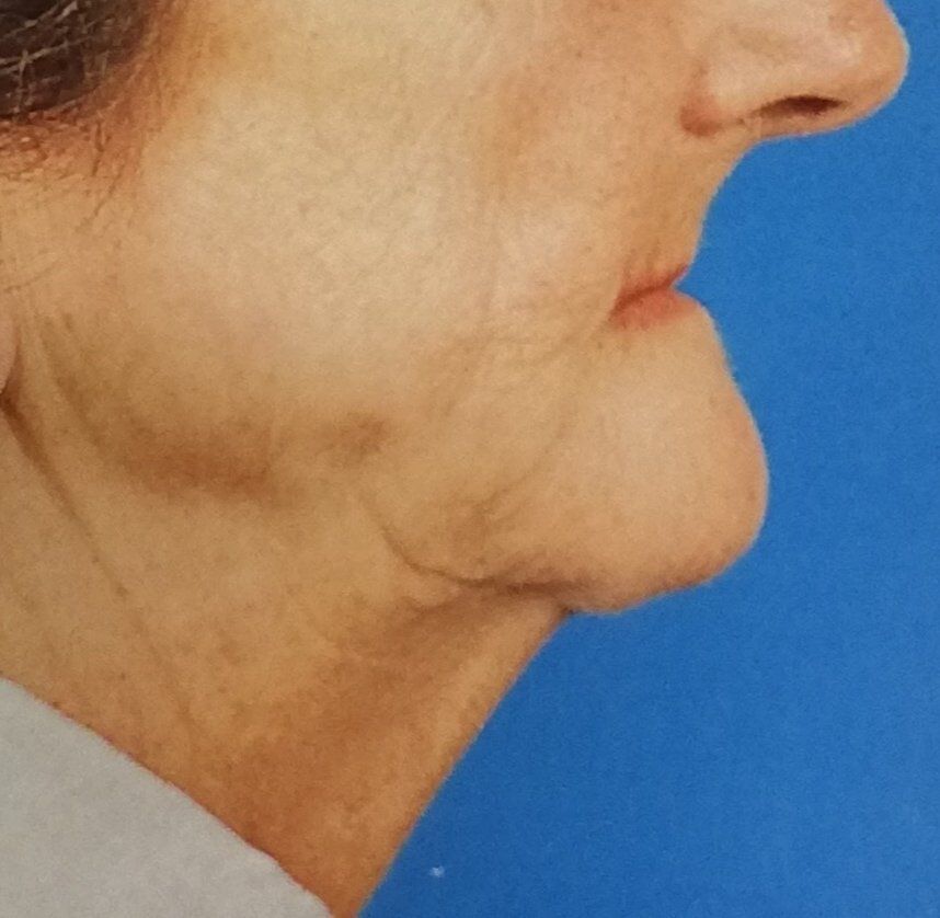 Profilo di paziente senza dentiera