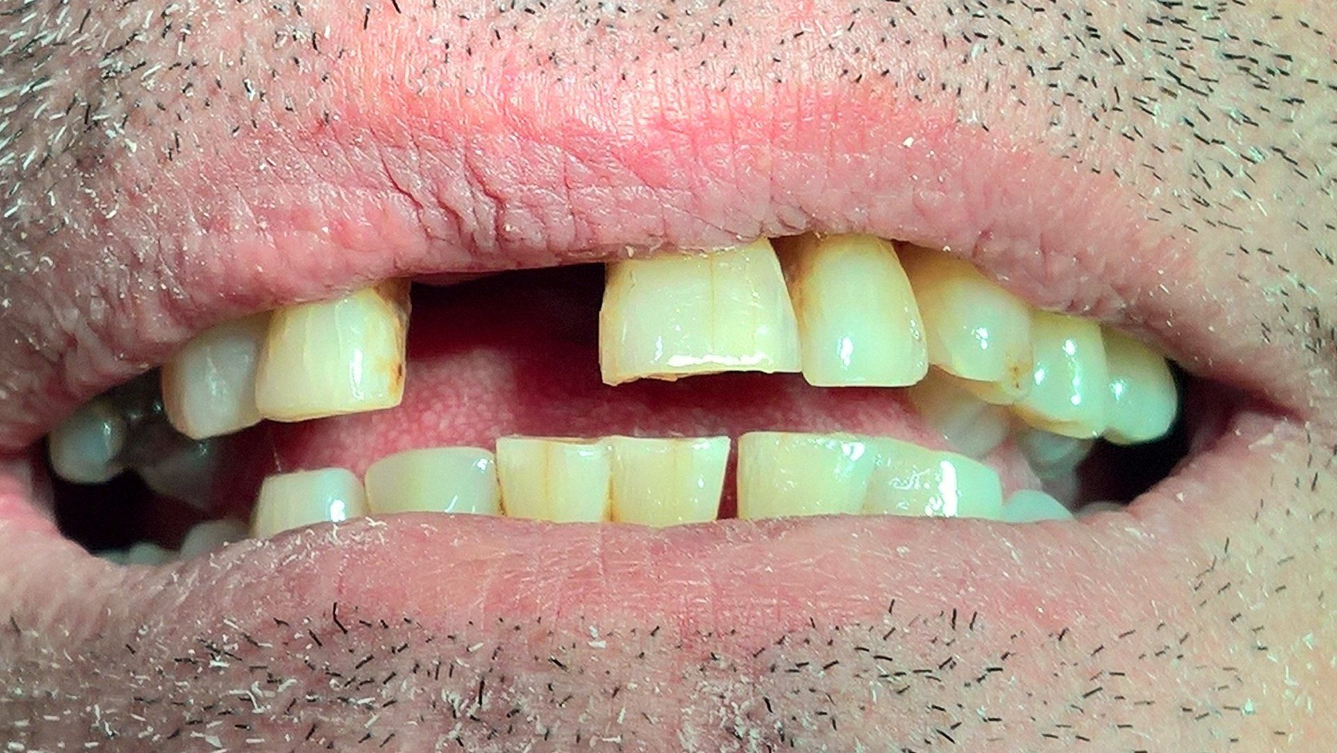 Paziente con bisogno di protesi mobile