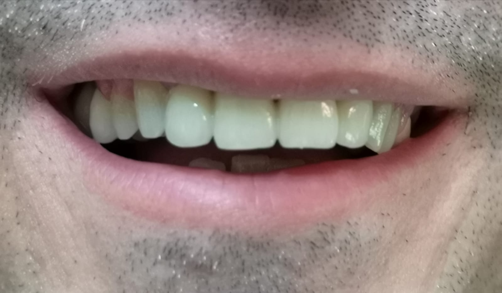 Primo piano della bocca sorridente di una persona, che mostra denti bianchi e dritti.