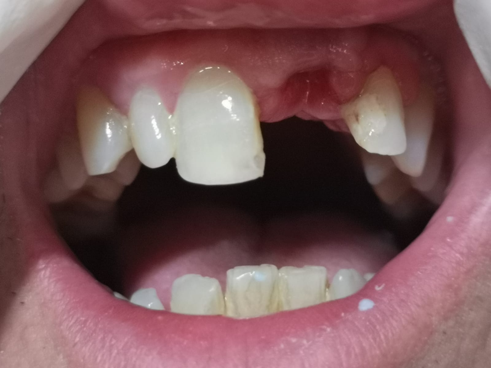 Protesi fisse, prima