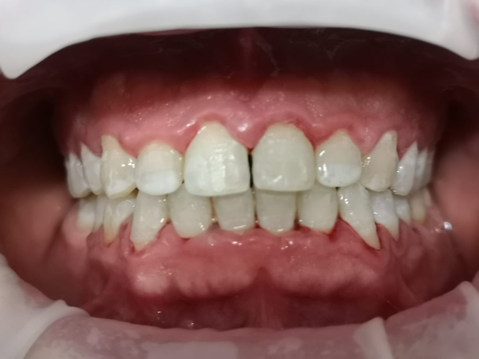 Riallineamento denti studio dentistico Lombardi, foto dopo il trattamento ortodontico