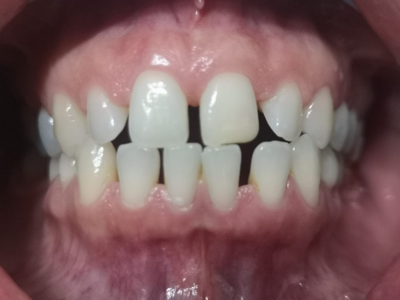 Riallineamento denti studio dentistico Lombardi, foto prima del trattamento