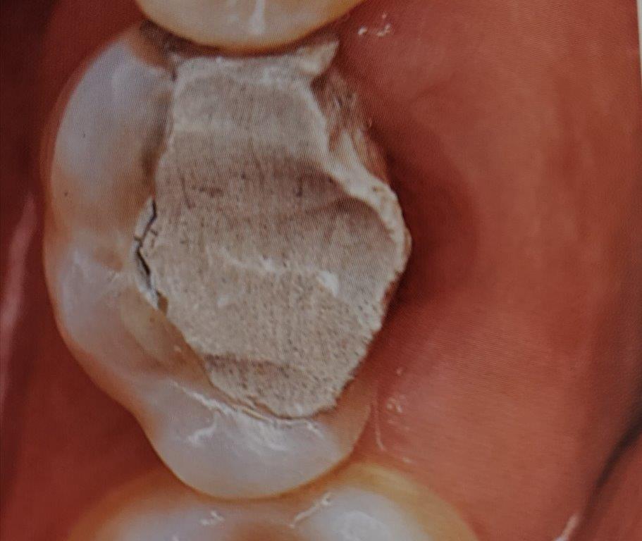 Primo piano di un dente con una grande otturazione chiara e usurata, circondata dalla gengiva rosa della bocca.