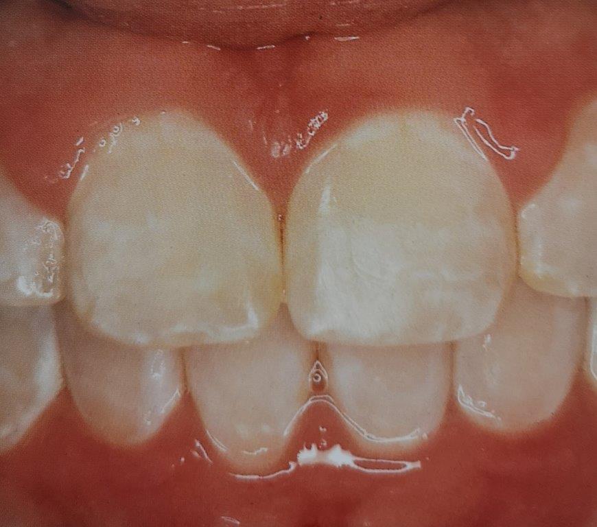Primo piano dei denti di una persona, che mostra i denti anteriori grandi e leggermente traslucidi, con una leggera scoloritura bianca.
