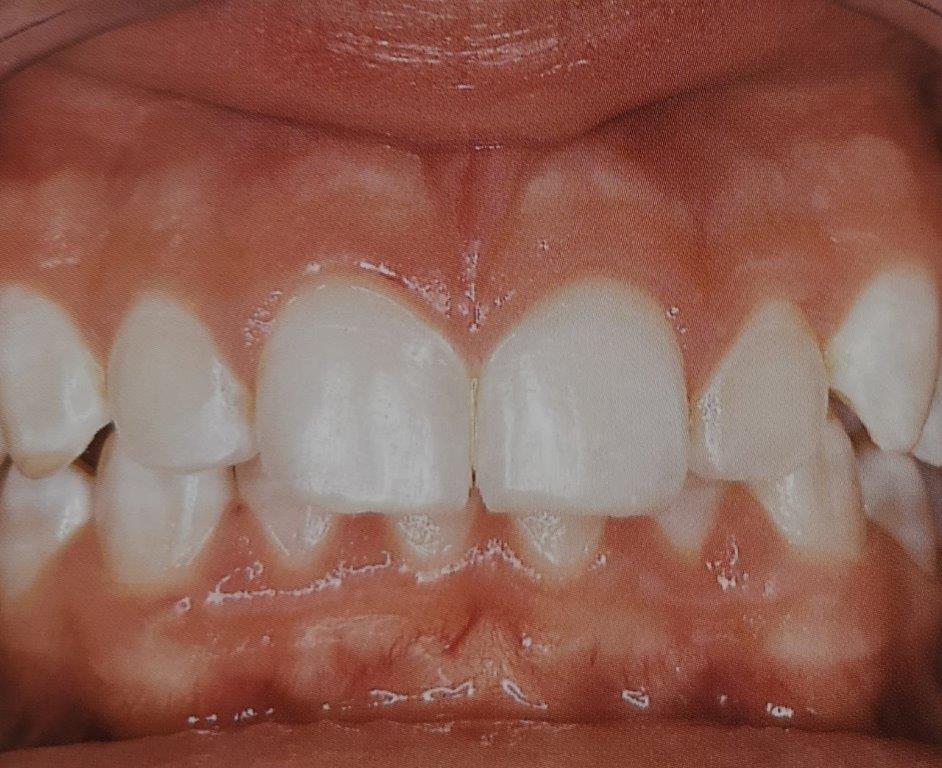 Primo piano dei denti di una persona; i denti anteriori sono bianchi e le gengive sono rosa.