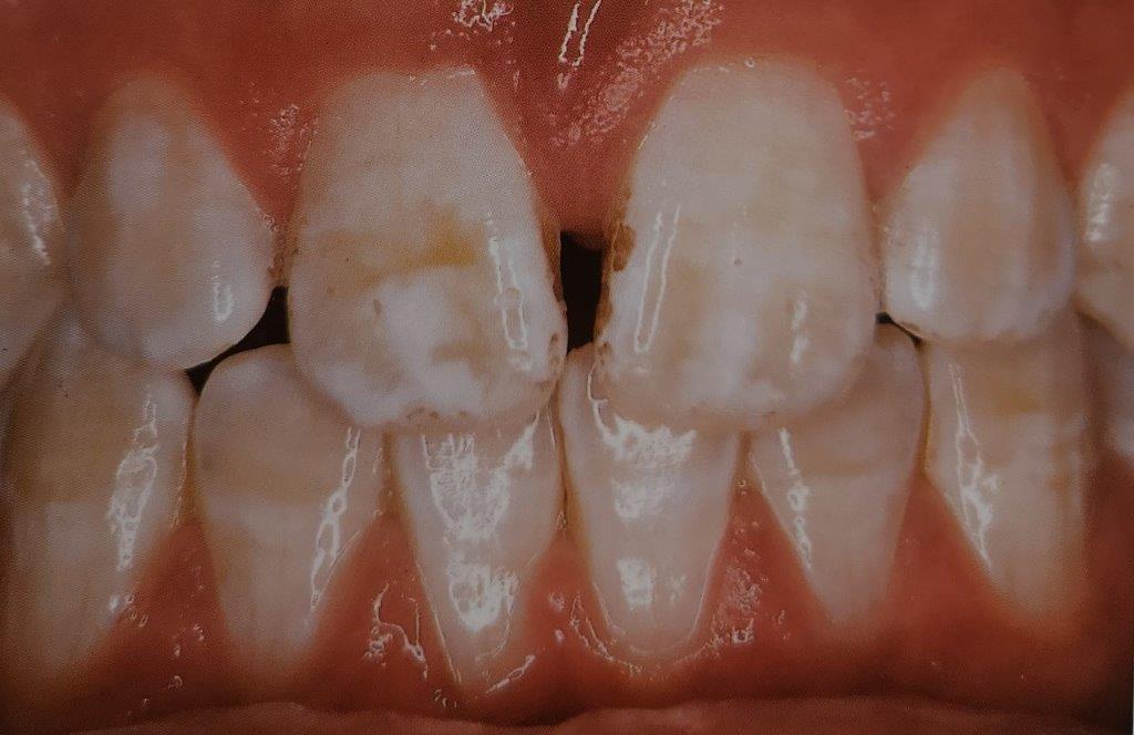Primo piano di denti con macchie bianche e leggera decolorazione marrone, probabilmente fluorosi dentale.