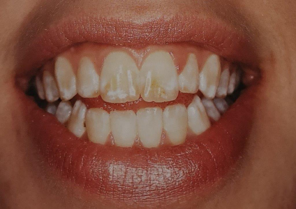 Primo piano della bocca di una persona che mostra i denti con macchie bianche, leggermente ingialliti e le labbra rosa.